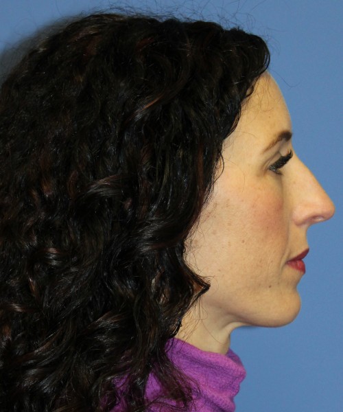 Rhinoplasty 3856 Click HERE for more views before photo. Individual results may vary.