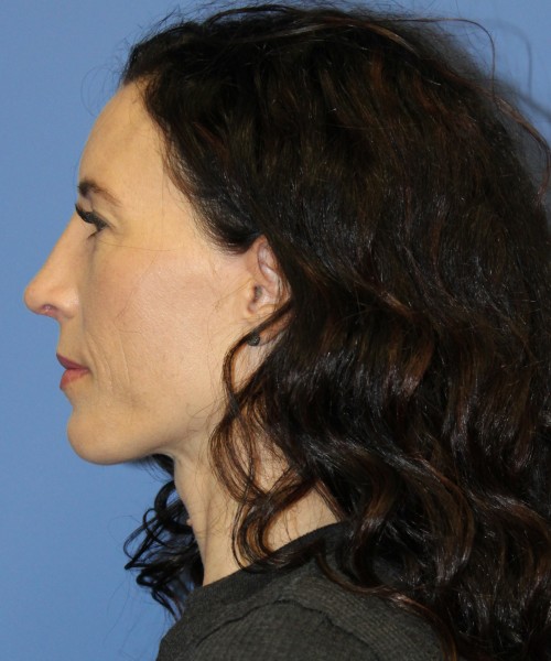Rhinoplasty 3856 Click HERE for more views after photo. Individual results may vary.