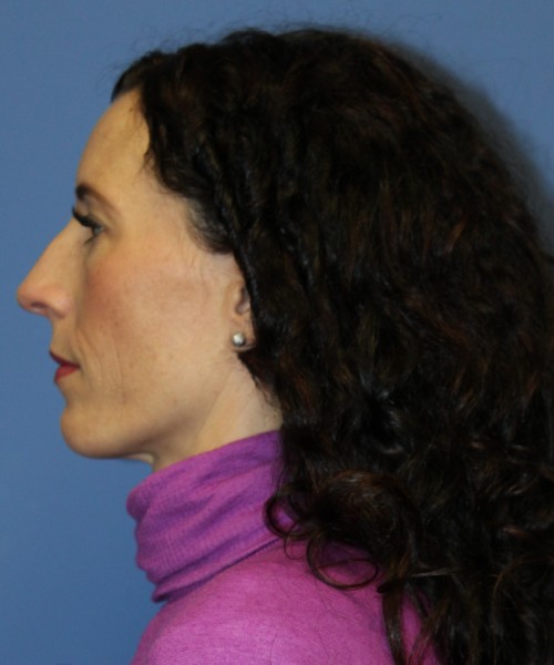 Rhinoplasty 3856 Click HERE for more views before photo. Individual results may vary.