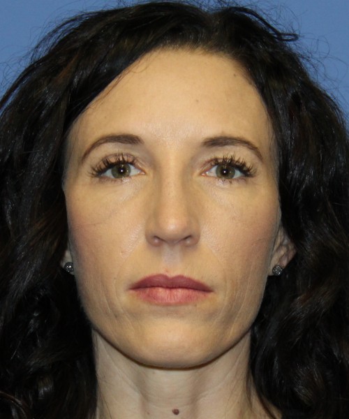 Rhinoplasty 3856 Click HERE for more views after photo. Individual results may vary.