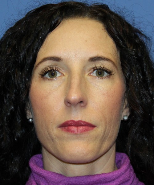 Rhinoplasty 3856 Click HERE for more views before photo. Individual results may vary.