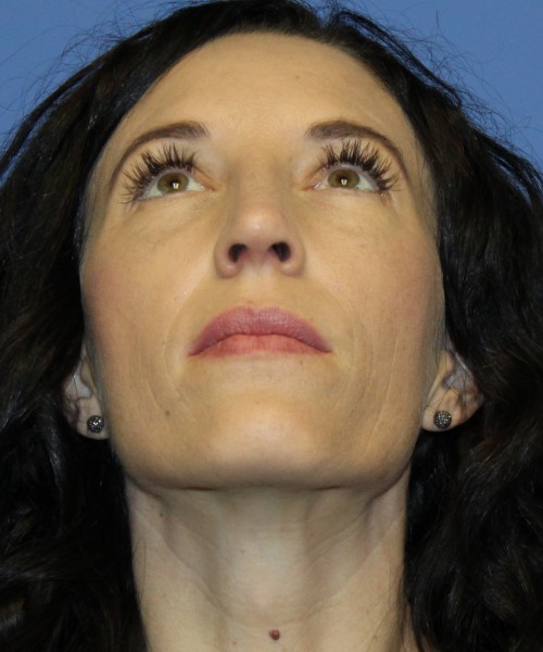 Rhinoplasty 3856 Click HERE for more views after photo. Individual results may vary.