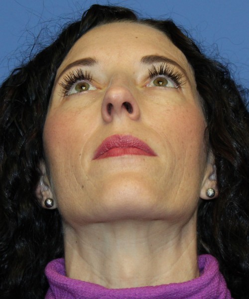 Rhinoplasty 3856 Click HERE for more views before photo. Individual results may vary.