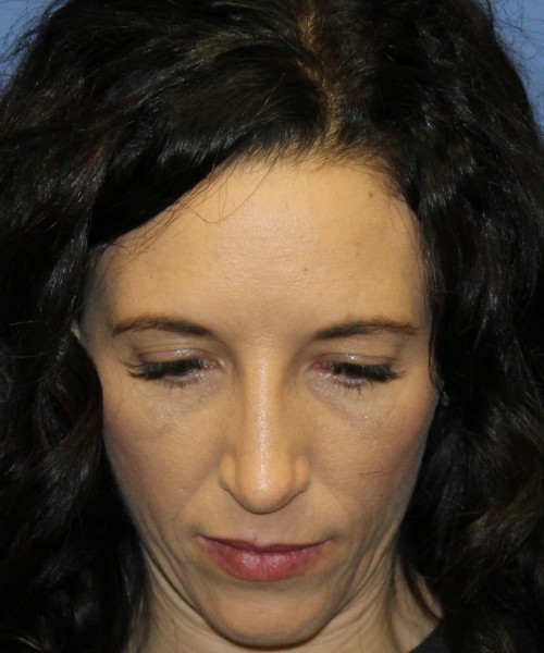 Rhinoplasty 3856 Click HERE for more views after photo. Individual results may vary.