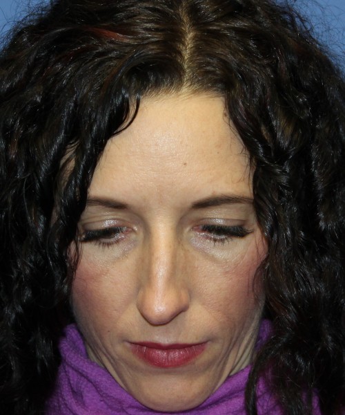 Rhinoplasty 3856 Click HERE for more views before photo. Individual results may vary.