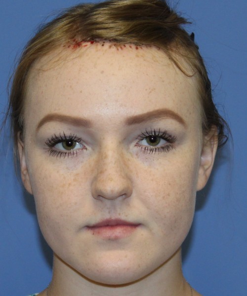 Hairline Advancement 4151 – Click HERE for more views after photo. Individual results may vary.