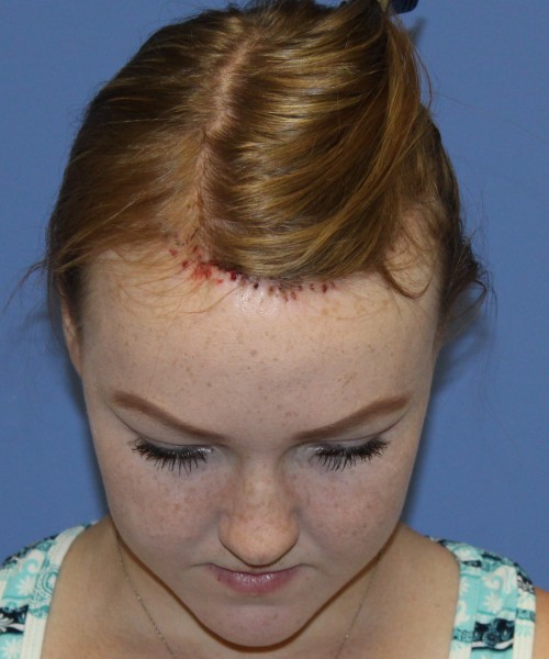 Hairline Advancement 4151 – Click HERE for more views after photo. Individual results may vary.
