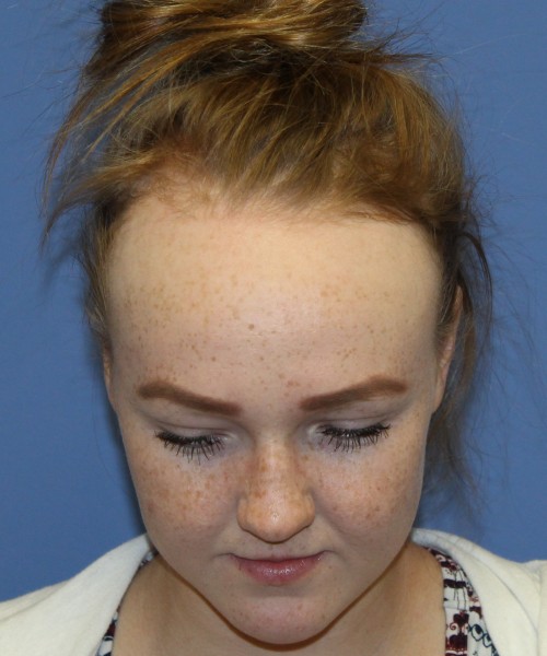 Hairline Advancement 4151 – Click HERE for more views before photo. Individual results may vary.