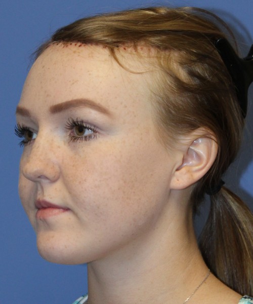Hairline Advancement 4151 – Click HERE for more views after photo. Individual results may vary.