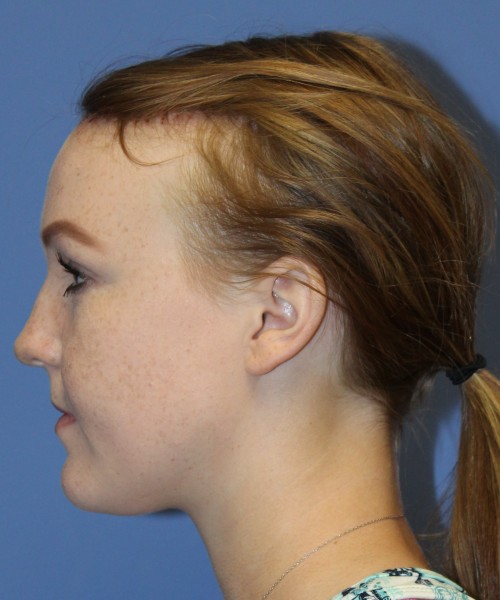 Hairline Advancement 4151 – Click HERE for more views after photo. Individual results may vary.