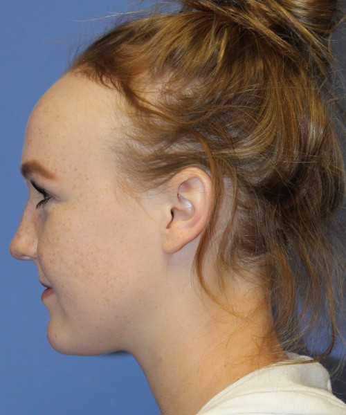 Hairline Advancement 4151 – Click HERE for more views before photo. Individual results may vary.