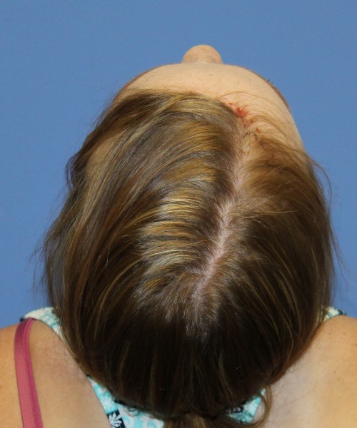 Hairline Advancement 4151 – Click HERE for more views after photo. Individual results may vary.
