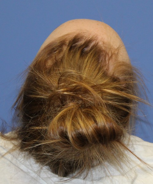 Hairline Advancement 4151 – Click HERE for more views before photo. Individual results may vary.