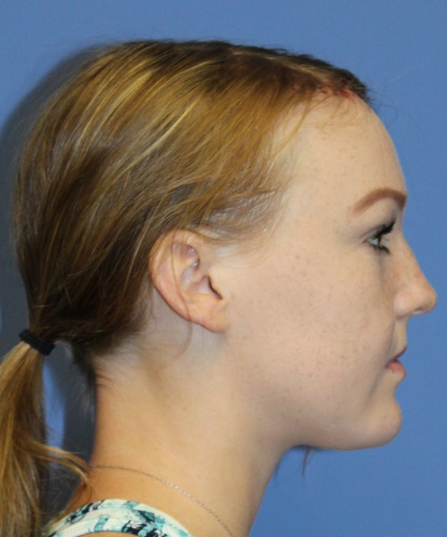 Hairline Advancement 4151 – Click HERE for more views after photo. Individual results may vary.
