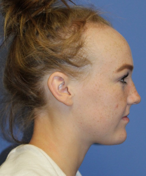 Hairline Advancement 4151 – Click HERE for more views before photo. Individual results may vary.