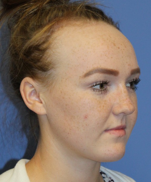 Hairline Advancement 4151 – Click HERE for more views before photo. Individual results may vary.