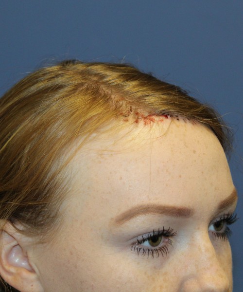 Hairline Advancement 4151 – Click HERE for more views after photo. Individual results may vary.
