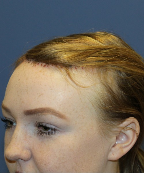 Hairline Advancement 4151 – Click HERE for more views after photo. Individual results may vary.
