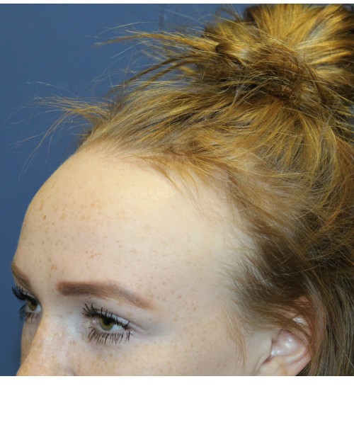 Hairline Advancement 4151 – Click HERE for more views before photo. Individual results may vary.