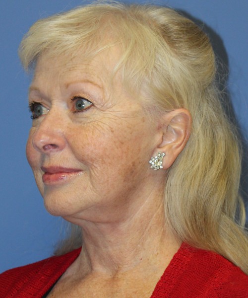 Facelift, Browlift, and SMAS Lip Augmentation 4182 – Click HERE for more views after photo. Individual results may vary.