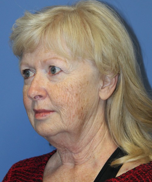 Facelift, Browlift, and SMAS Lip Augmentation 4182 – Click HERE for more views before photo. Individual results may vary.