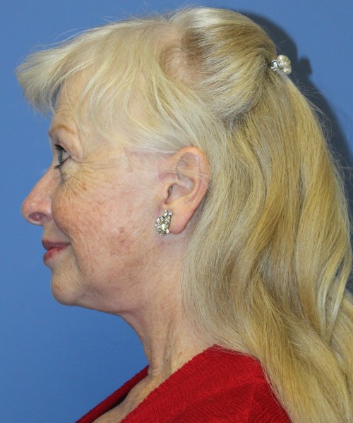 Facelift, Browlift, and SMAS Lip Augmentation 4182 – Click HERE for more views after photo. Individual results may vary.