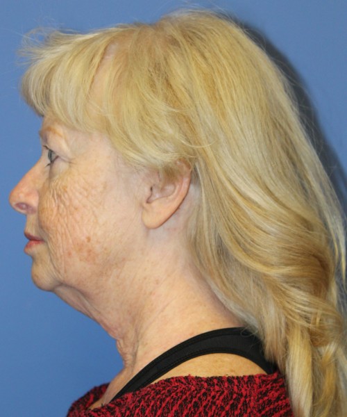 Facelift, Browlift, and SMAS Lip Augmentation 4182 – Click HERE for more views before photo. Individual results may vary.