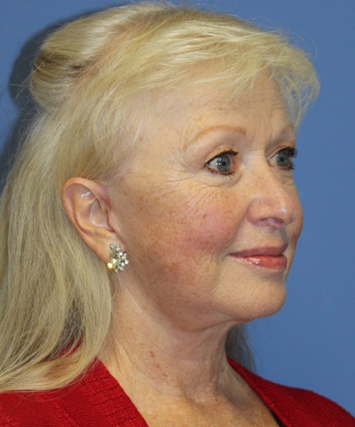Facelift, Browlift, and SMAS Lip Augmentation 4182 – Click HERE for more views after photo. Individual results may vary.