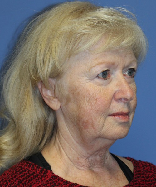 Facelift, Browlift, and SMAS Lip Augmentation 4182 – Click HERE for more views before photo. Individual results may vary.