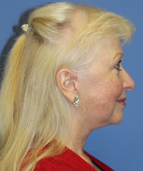 Facelift, Browlift, and SMAS Lip Augmentation 4182 – Click HERE for more views after photo. Individual results may vary.