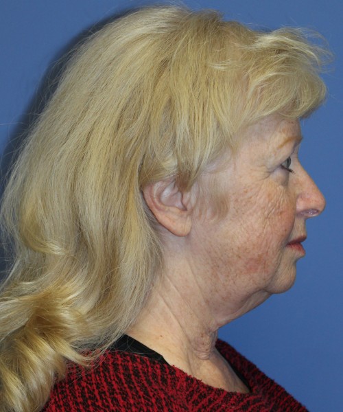 Facelift, Browlift, and SMAS Lip Augmentation 4182 – Click HERE for more views before photo. Individual results may vary.