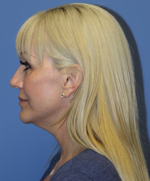 Revision Facelift, Browlift, Rhinoplasty, SMAS lip augmentation 4194 – Click HERE for more views before photo. Individual results may vary.