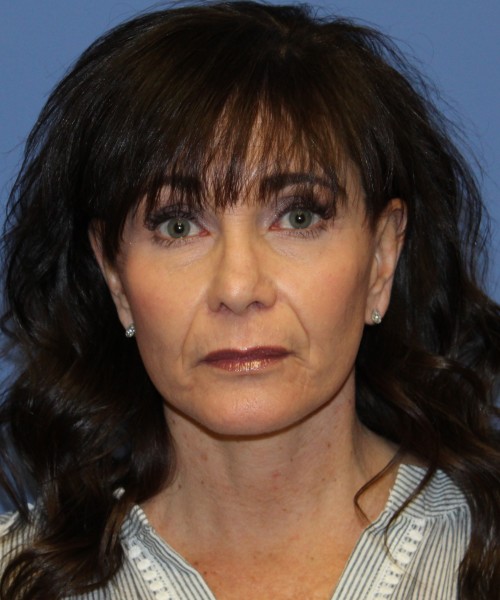 Facelift, Browlift, SMAS Lip Augmentation, Laser Skin Resurfacing 4208 – Click HERE for more views after photo. Individual results may vary.