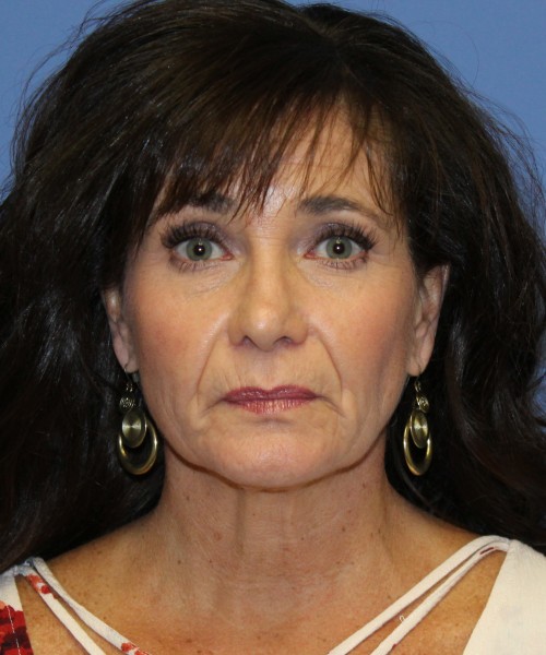 Facelift, Browlift, SMAS Lip Augmentation, Laser Skin Resurfacing 4208 – Click HERE for more views before photo. Individual results may vary.
