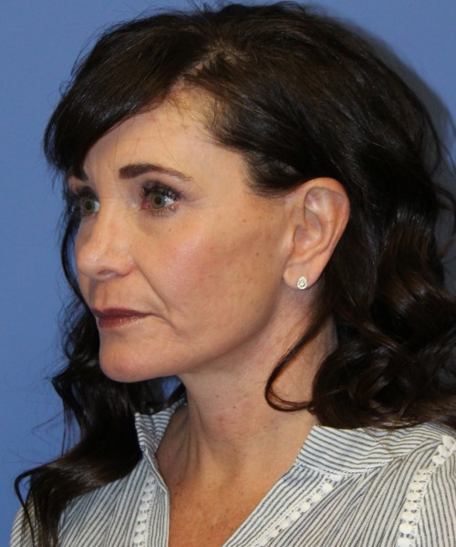 Facelift, Browlift, SMAS Lip Augmentation, Laser Skin Resurfacing 4208 – Click HERE for more views after photo. Individual results may vary.