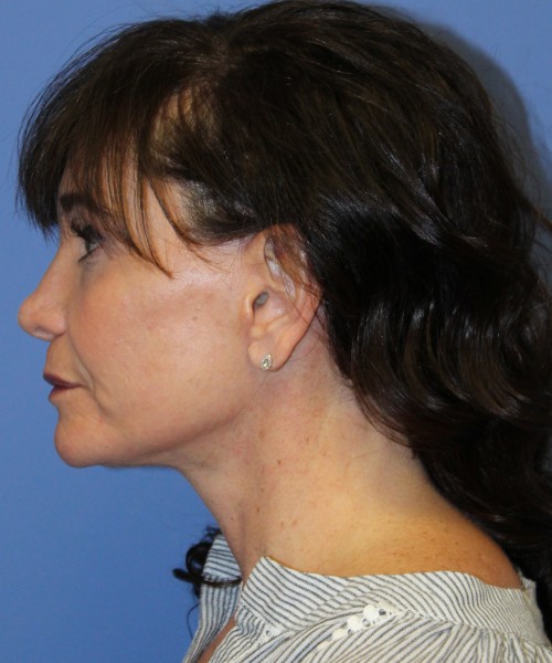 Facelift, Browlift, SMAS Lip Augmentation, Laser Skin Resurfacing 4208 – Click HERE for more views after photo. Individual results may vary.