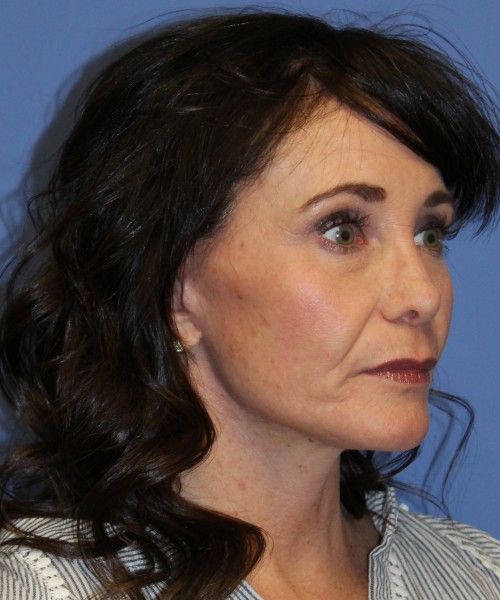 Facelift, Browlift, SMAS Lip Augmentation, Laser Skin Resurfacing 4208 – Click HERE for more views after photo. Individual results may vary.