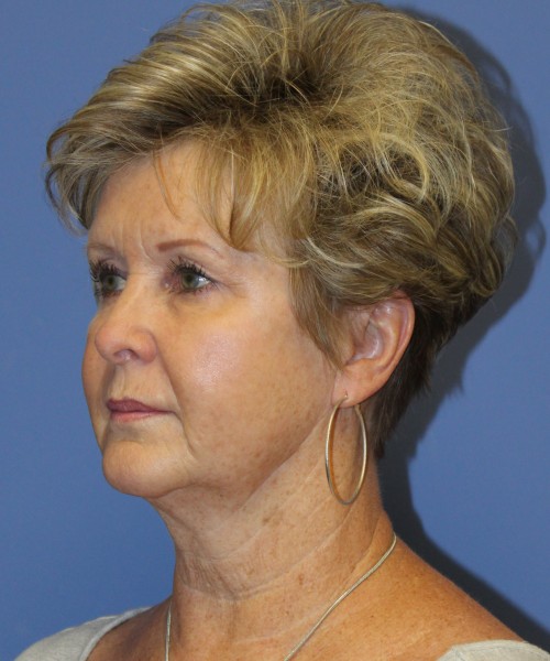 Facelift, Browlift, SMAS Lip Augmentation, Laser Skin Resurfacing 4222 – Click HERE for more views before photo. Individual results may vary.