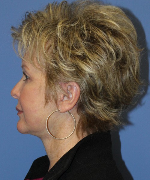 Facelift, Browlift, SMAS Lip Augmentation, Laser Skin Resurfacing 4222 – Click HERE for more views after photo. Individual results may vary.