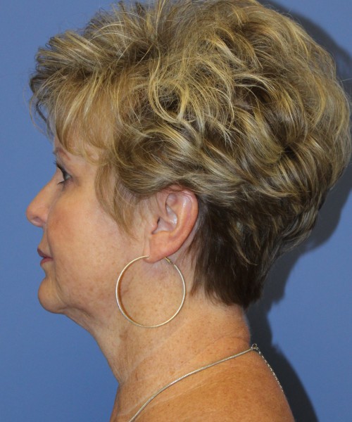 Facelift, Browlift, SMAS Lip Augmentation, Laser Skin Resurfacing 4222 – Click HERE for more views before photo. Individual results may vary.