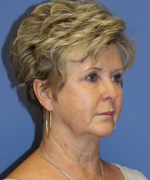 Facelift, Browlift, SMAS Lip Augmentation, Laser Skin Resurfacing 4222 – Click HERE for more views before photo. Individual results may vary.
