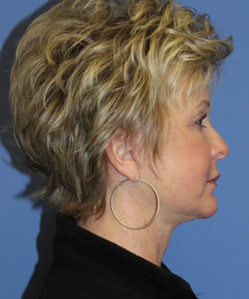 Facelift, Browlift, SMAS Lip Augmentation, Laser Skin Resurfacing 4222 – Click HERE for more views after photo. Individual results may vary.