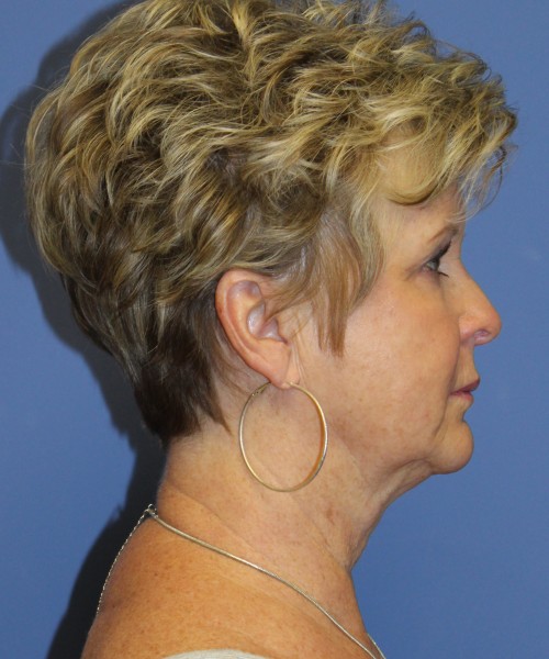 Facelift, Browlift, SMAS Lip Augmentation, Laser Skin Resurfacing 4222 – Click HERE for more views before photo. Individual results may vary.