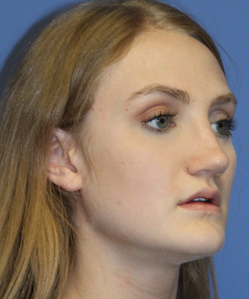 Revision Rhinoplasty 4234 – Click HERE for more views after photo. Individual results may vary.