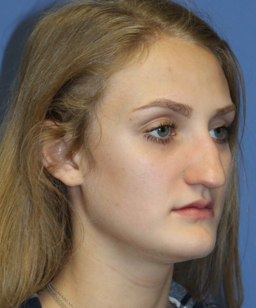 Revision Rhinoplasty 4234 – Click HERE for more views before photo. Individual results may vary.