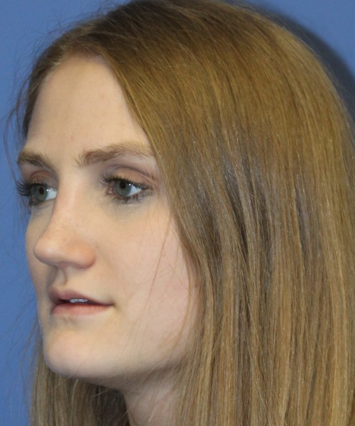 Revision Rhinoplasty 4234 – Click HERE for more views after photo. Individual results may vary.