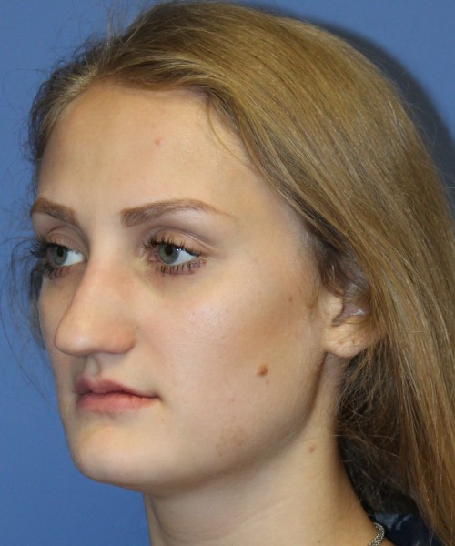 Revision Rhinoplasty 4234 – Click HERE for more views before photo. Individual results may vary.