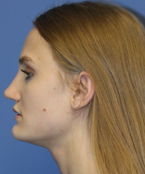 Revision Rhinoplasty 4234 – Click HERE for more views after photo. Individual results may vary.