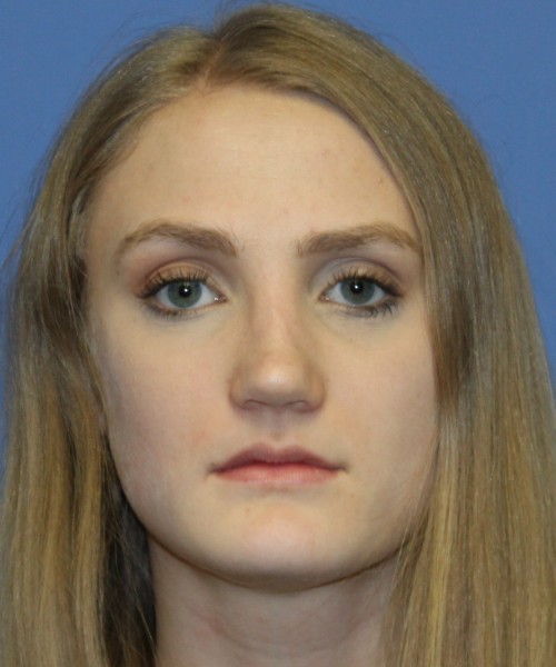 Revision Rhinoplasty 4234 – Click HERE for more views after photo. Individual results may vary.
