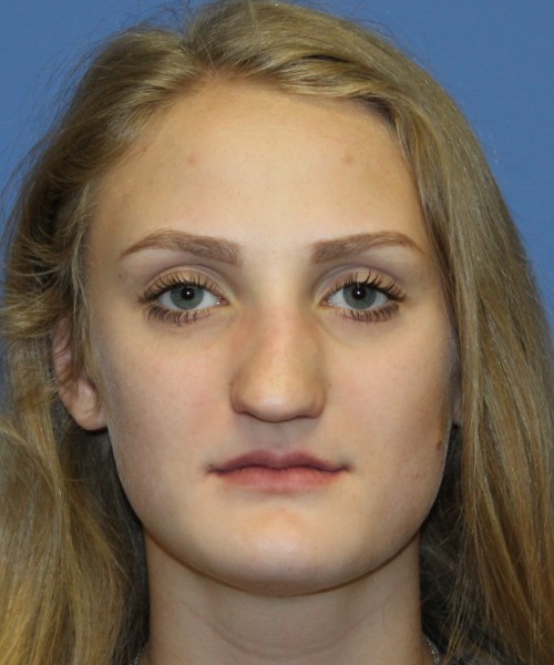 Revision Rhinoplasty 4234 – Click HERE for more views before photo. Individual results may vary.